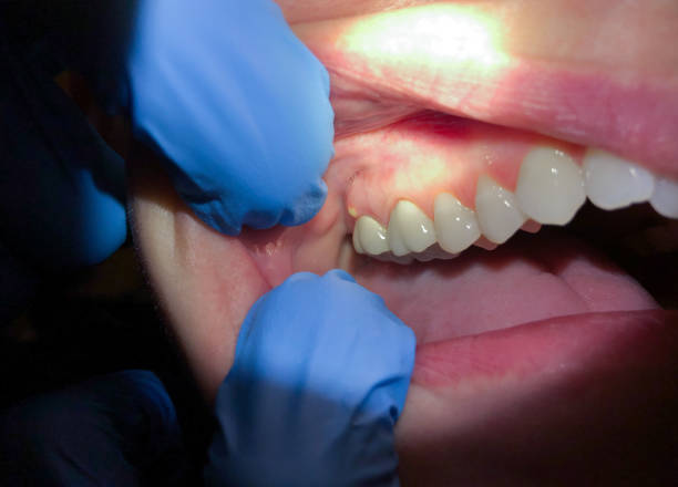 Best Knocked-Out Tooth (Avulsed Tooth) Treatment in Sa Loma, CA